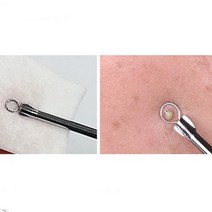 피지 여드름 비립종 블랙헤드 제거기 택1 스틱 짜는 도구 압출 바늘 피부과, 롱라운드형