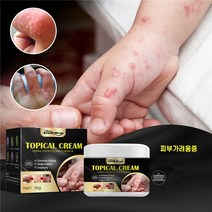 피부가려움증 크림 한포진 지루성피부염 습진연고 여드름 모낭염연고, 2개