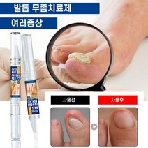 발톱무좀치료 발톱무좀약 손발톱 네일 리페어 강화 에센스, 3ml, 1개
