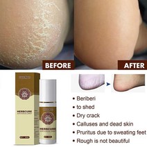60ml 곰팡이 전투 발 스프레이 발 살균 스프레이 허브 항진균제 손 보습 제거 굳은살 죽은 피부 손 발 자동차