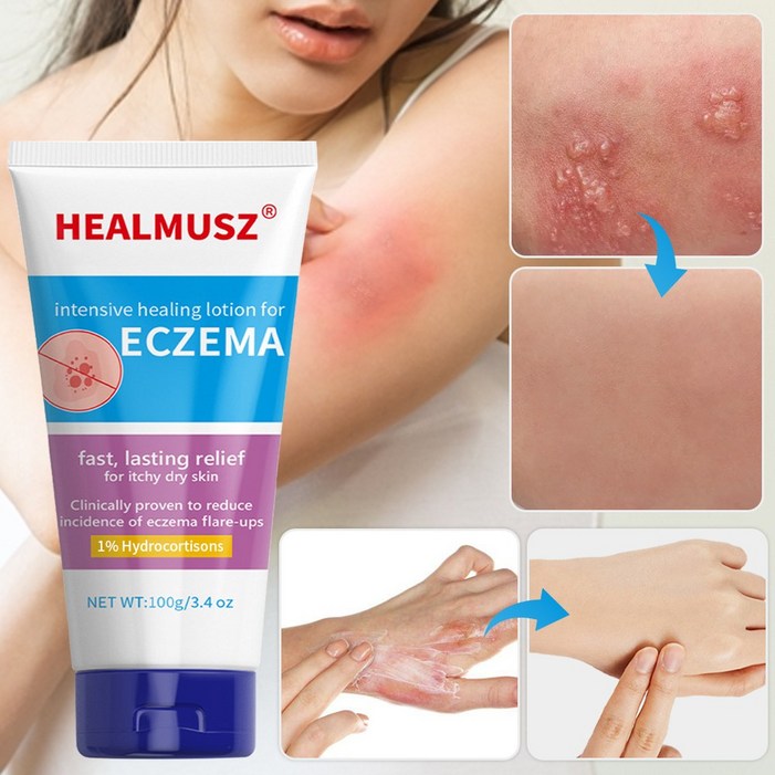 국내발송습진연고 한포진 두드러기 습진 입술포진 땀띠연고 멀티 피부 가려움 종합 관리 연고, 2개, 100ml